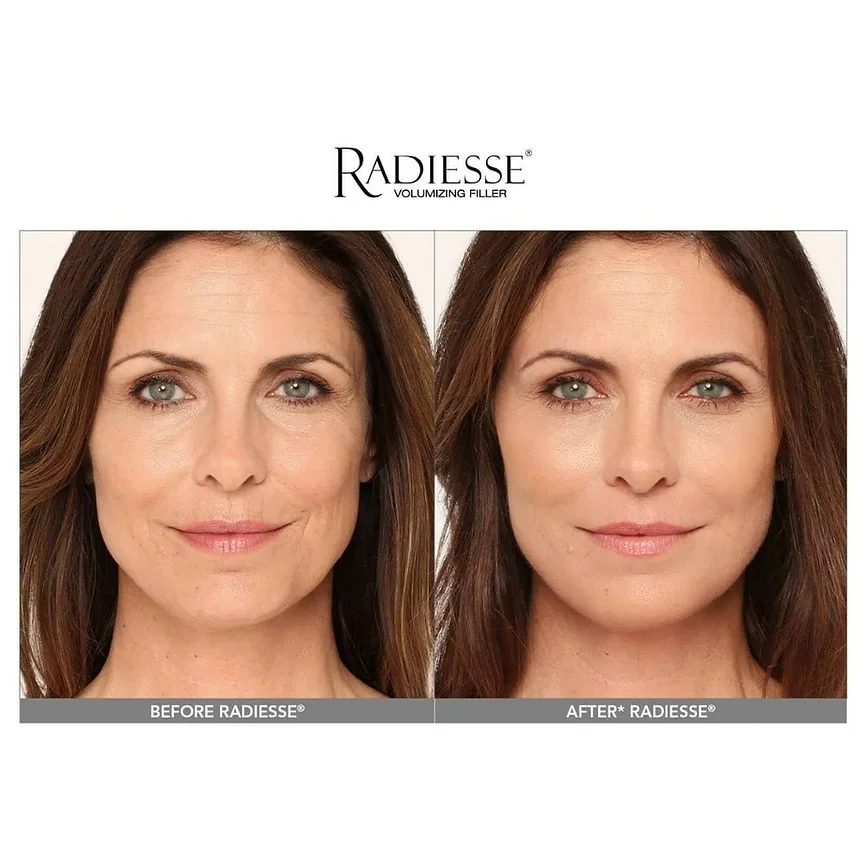 Radiesse before and after images of a Woman | Frederick, MD