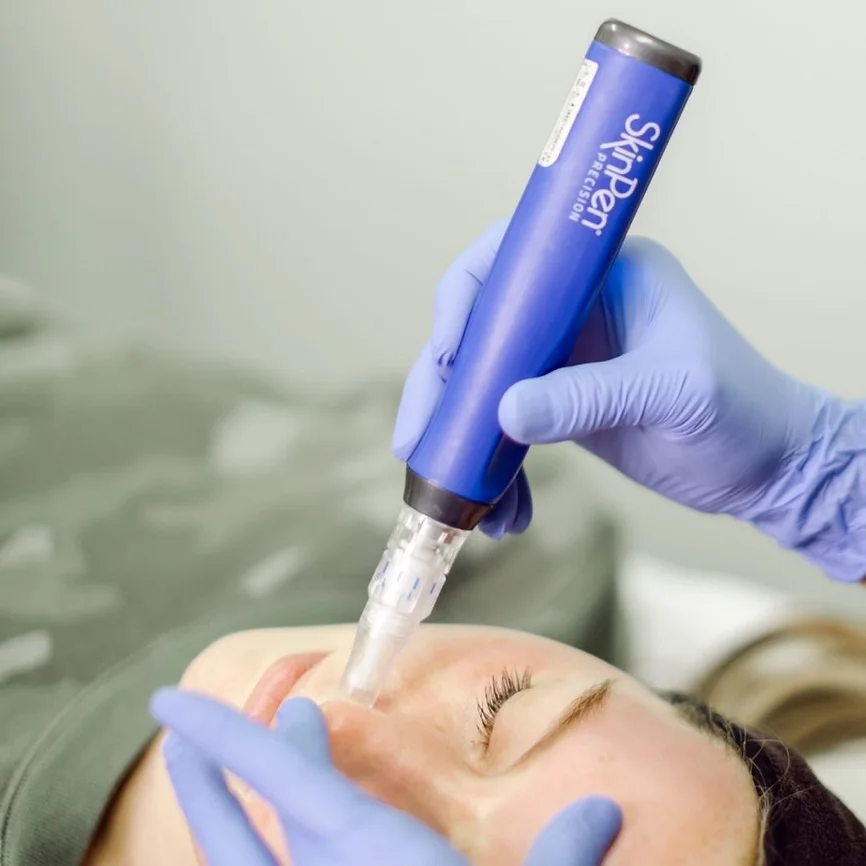 Woman getting Skinpen Microneedling services in frederick, md
