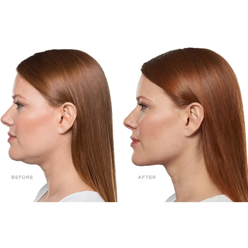 Kybella Before and After of a woman | Frederick, MD