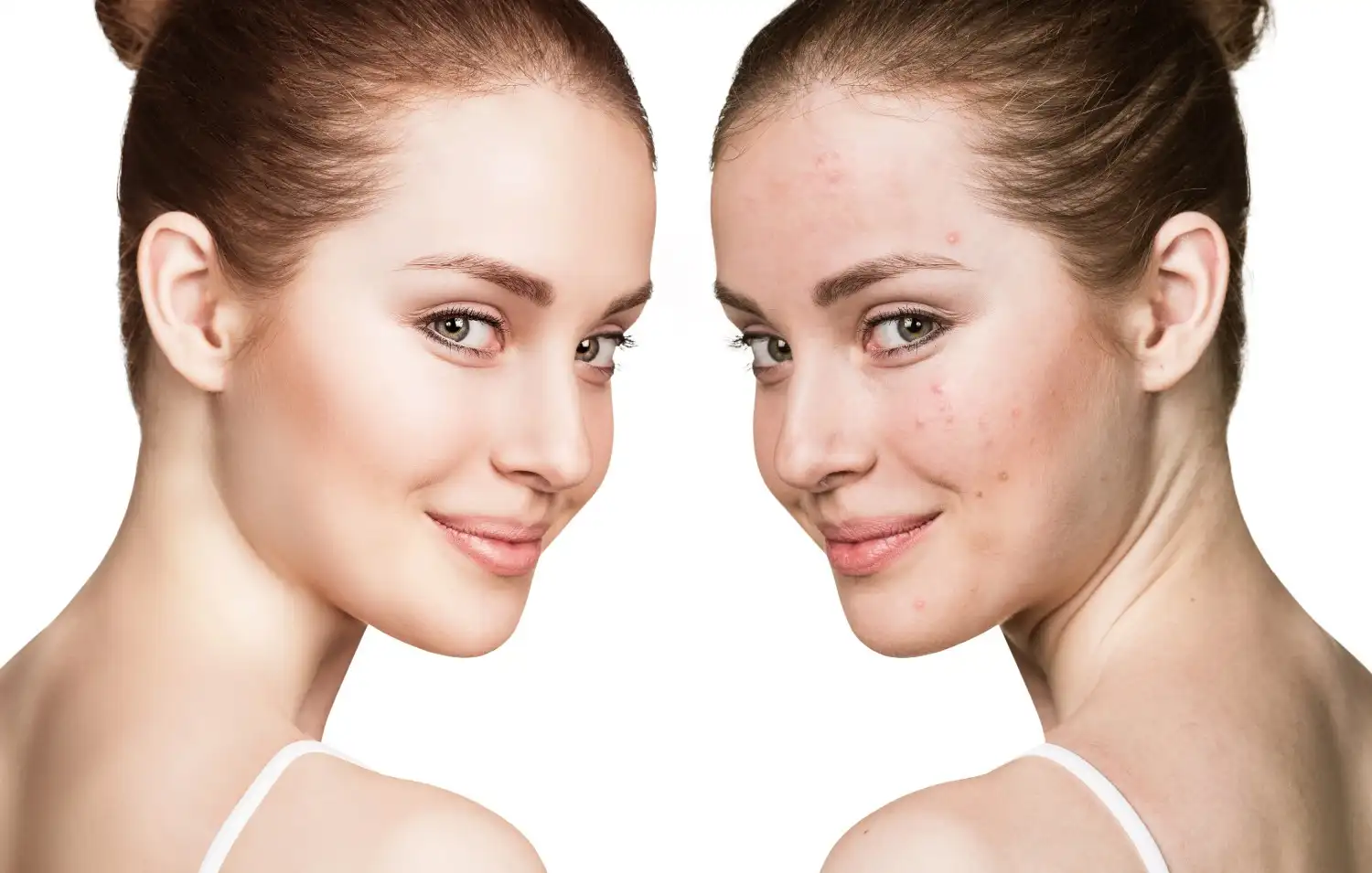 Why Your Acne Scars Aren't Improving